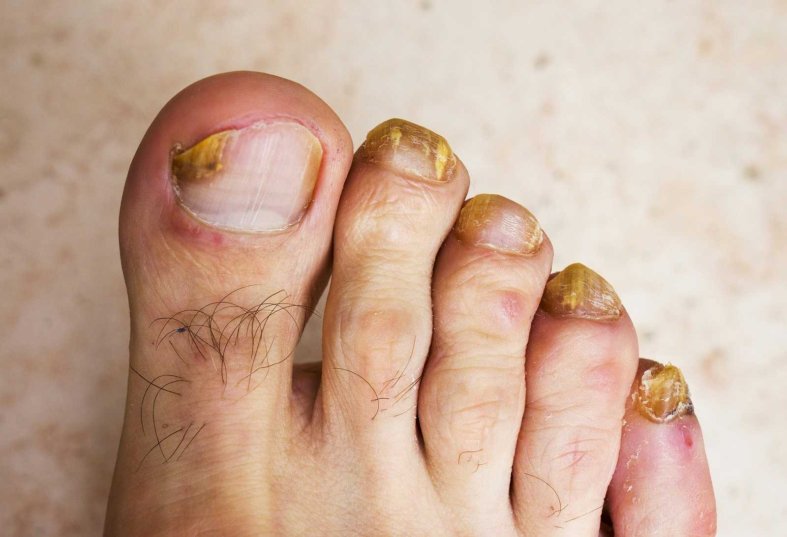Try this life-changing product for thick toenails: Central