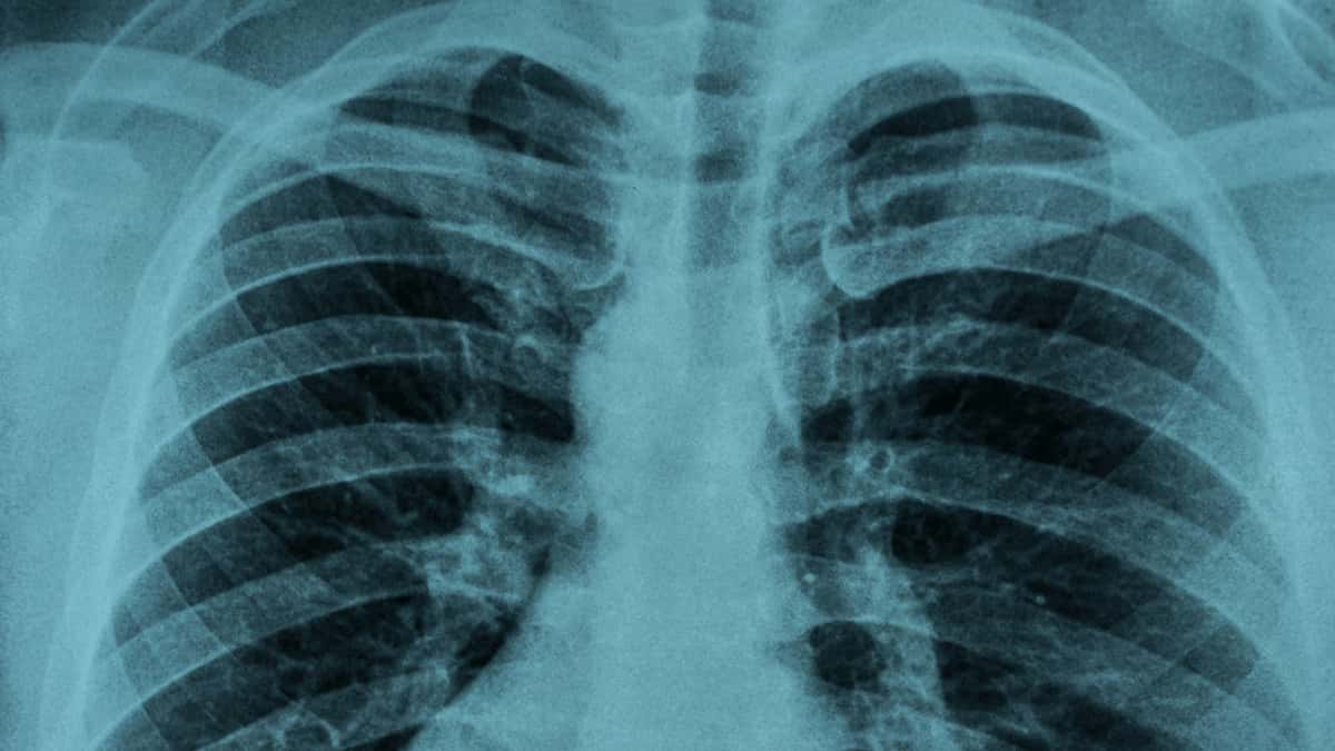 Why Is It So Hard to Diagnose Pneumonia Correctly? | The People's Pharmacy